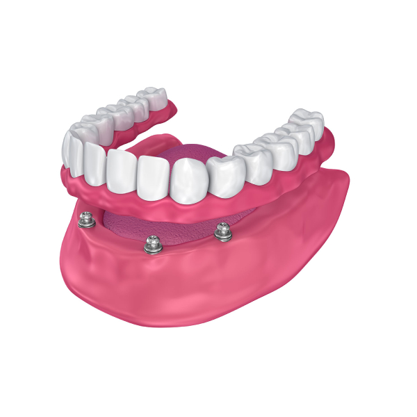what-is-an-overdenture